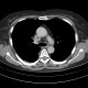 Thrombosis of superior vena cava: CT - Computed tomography